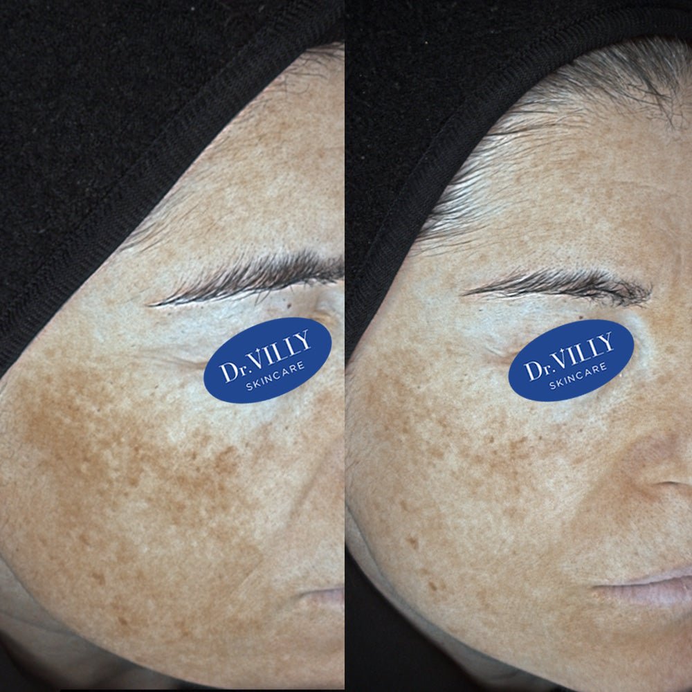 C+F Serum - 30ml - Dr. Villy Skincare - Medical Grade product
