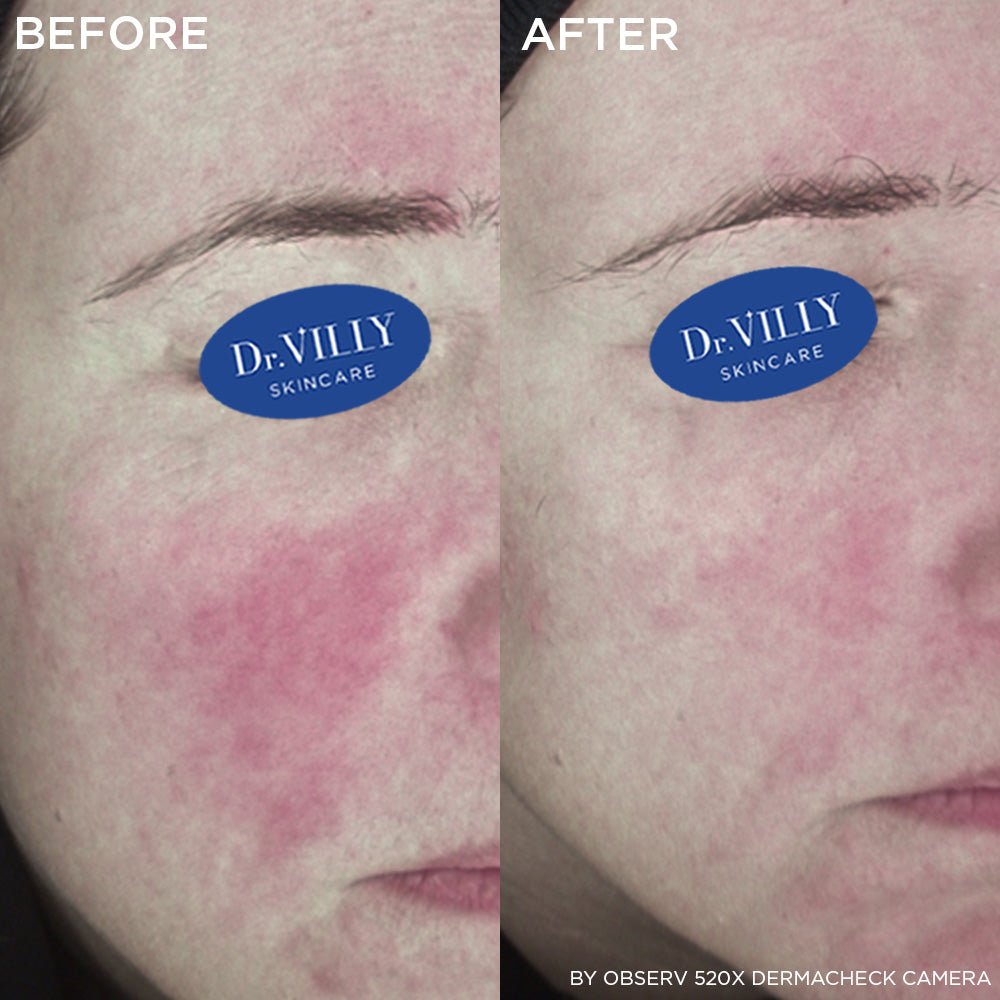 Exosomes Face, Neck & Décolleté Cream - 30ml - Dr. Villy Skincare - Medical Grade product