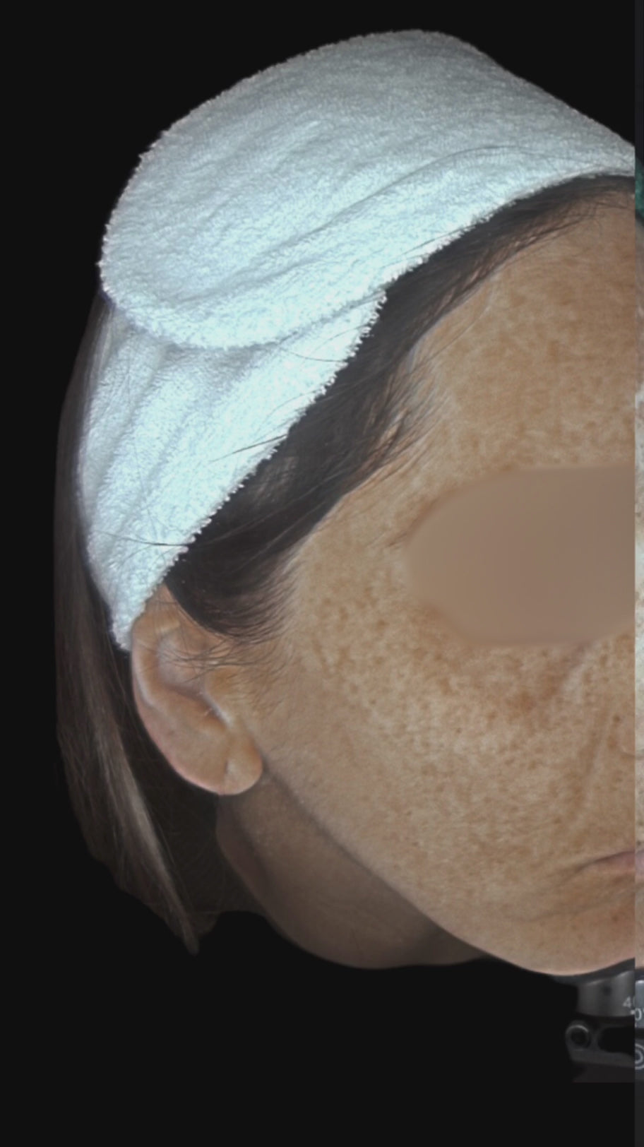 Before and After image of results after applying C+F Serum from Dr. Villy Skincare - Medical Grade, vitamin C & ferulic acid brightening serum for even, glowing skin tone