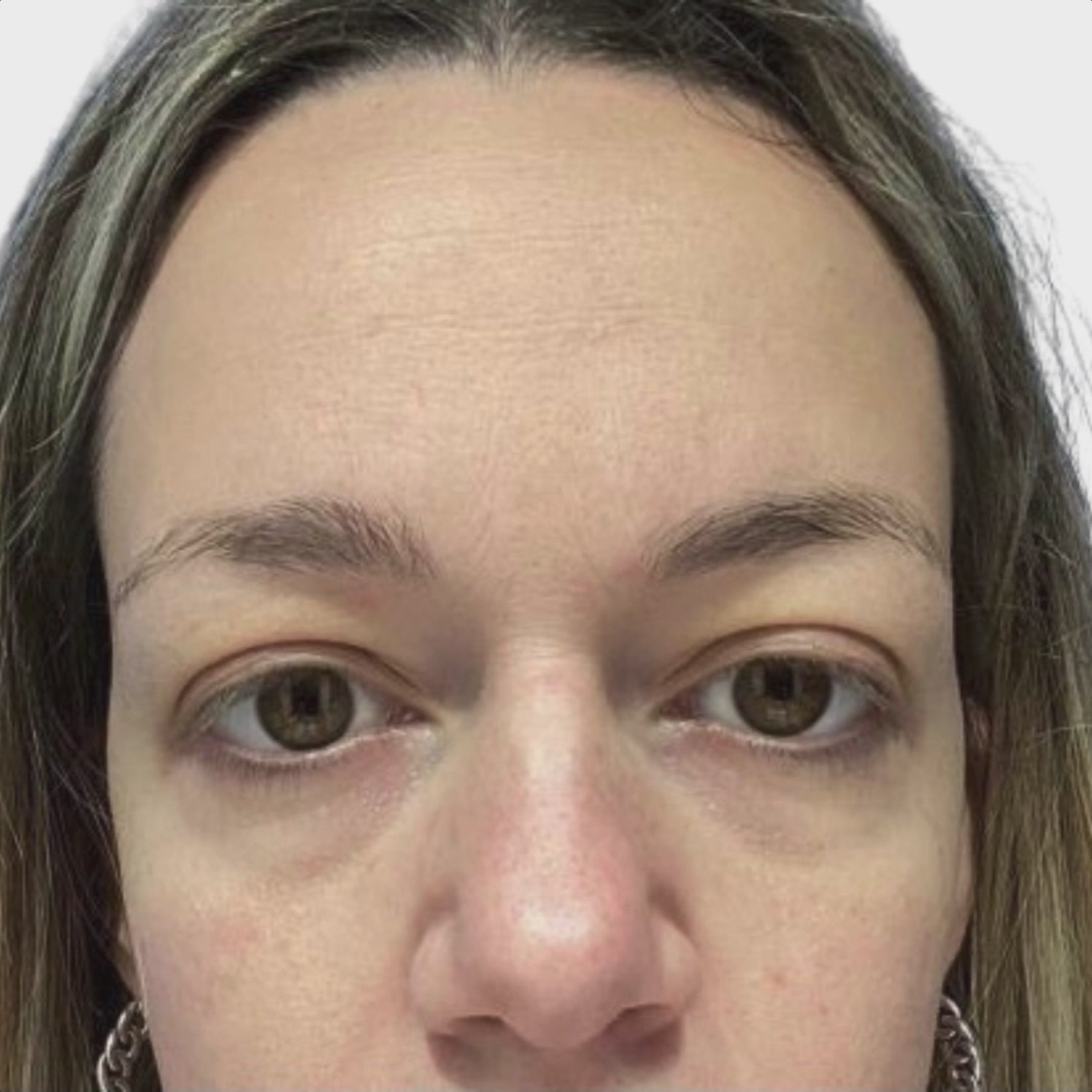Before and After clip of results after applying Eye Rejuvenation from Dr. Villy Skincare