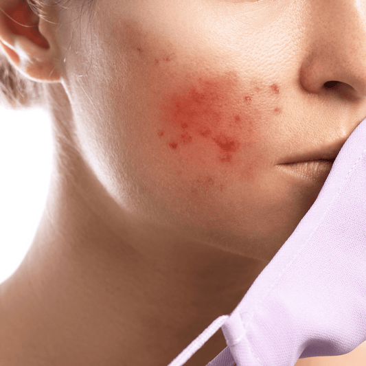 Let’s talk about Rosacea openly, honestly, and with real solutions - Dr. Villy Skincare