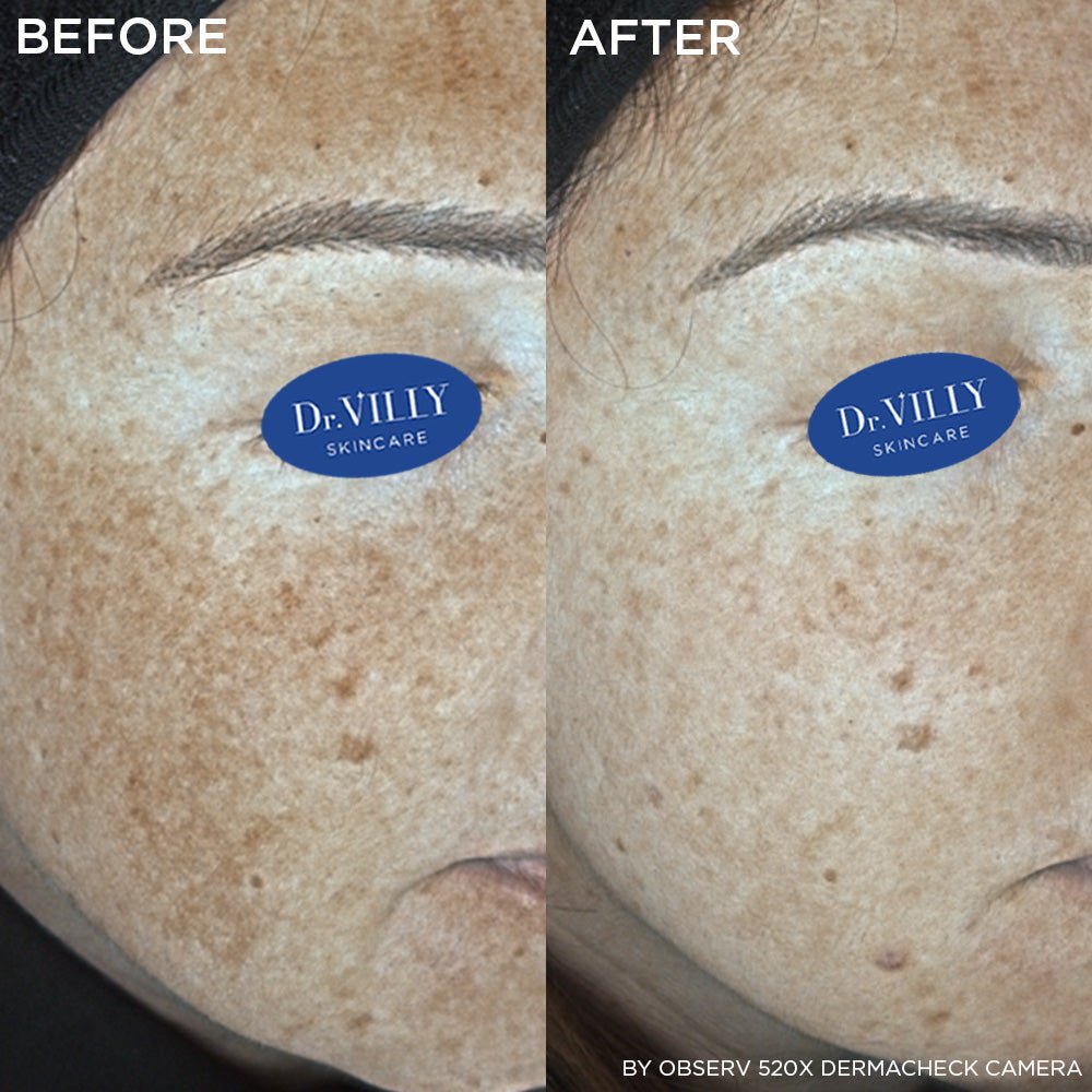 B+R Serum - 30ml - Dr. Villy Skincare - Medical Grade product