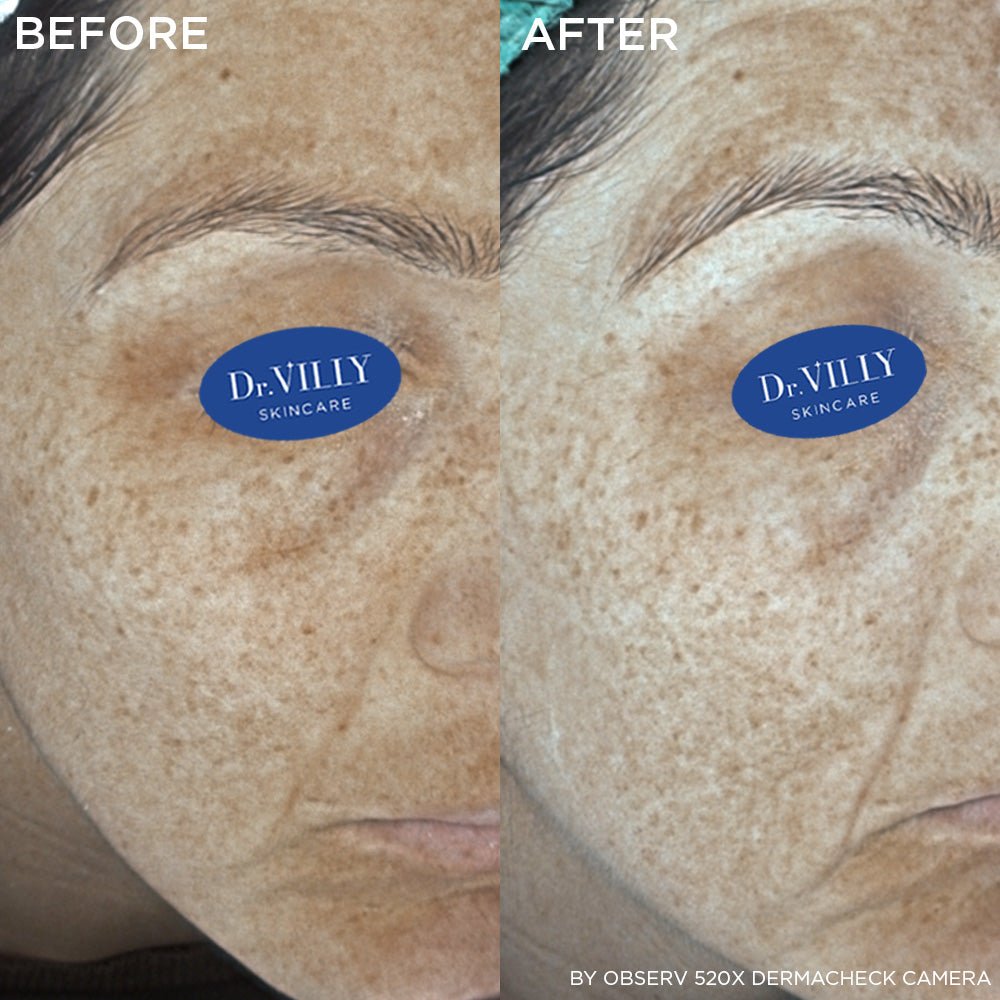 Brightening & Anti - Pigment Cream - 30ml - Dr. Villy Skincare - Medical Grade product