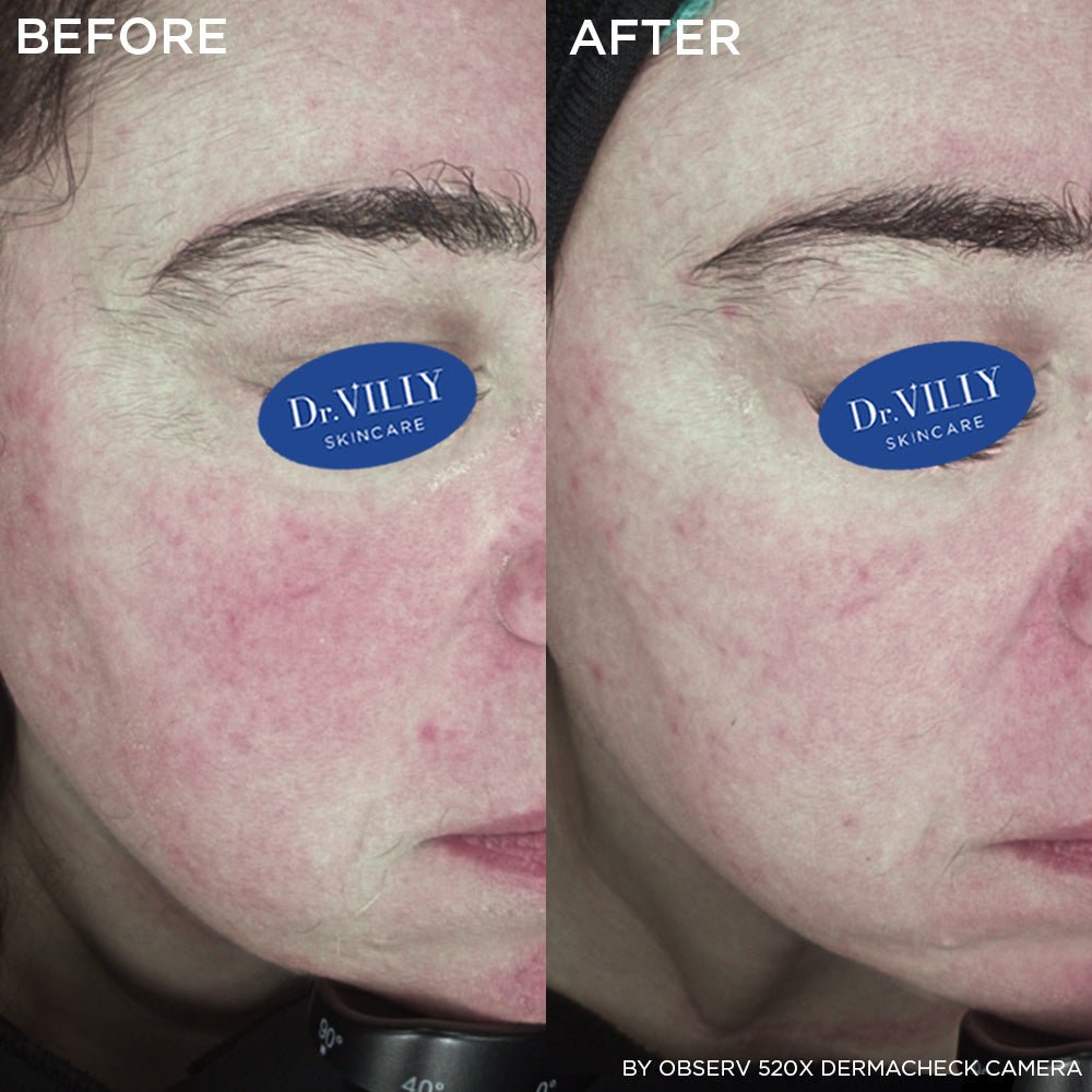 H+N Serum - 30ml - Dr. Villy Skincare - Medical Grade product